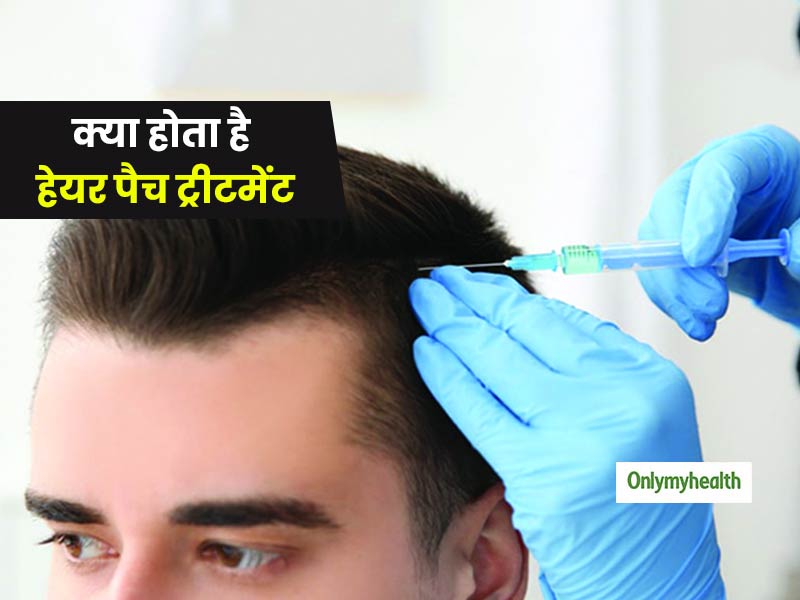 बालों के बीच में पड़े गड्ढों को दूर करने में कारगर है हेयर पैच ट्रीटमेंट, एक्सपर्ट से जानें हर जरूरी बात